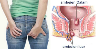 Ambeien Karena Apa