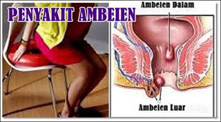 Ambeien Jadi Susah Bab