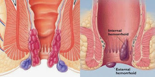 Resiko Ambeien Saat Melahirkan